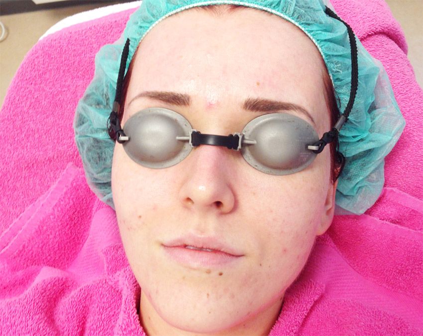 haar laserapparaat